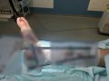 Ребенка с травмой от бензопилы спасли врачи Вологодской областной детской клинической больницы