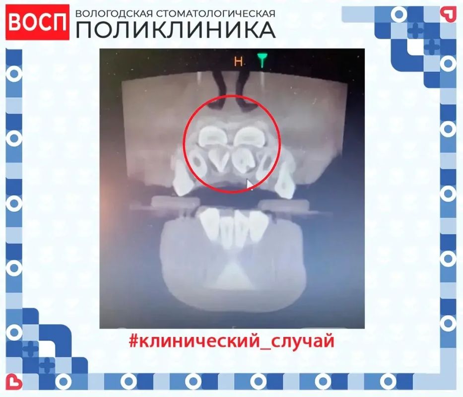 Вологодские стоматологи рассказали о сложном случае задержки прорезывания постоянных зубов