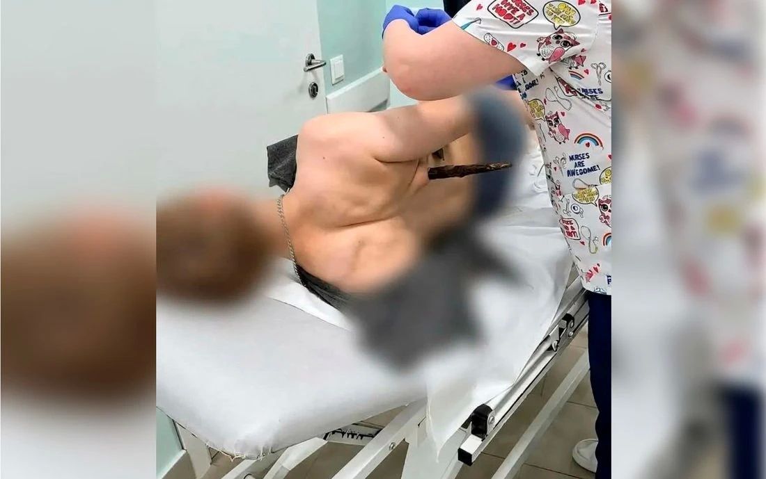 Врачи спасли 18-летнего череповчанина с проникающим ранением грудной клетки